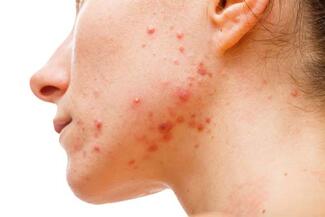 acne on face