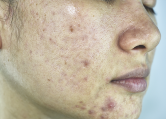 acne on womens face