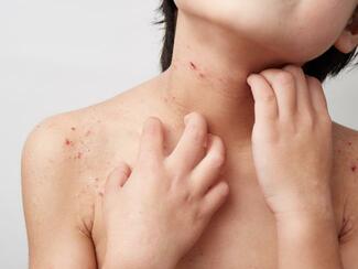 child scratching eczema
