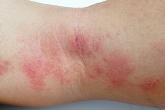 eczema arm