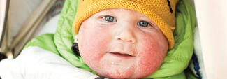 baby with dermatitis