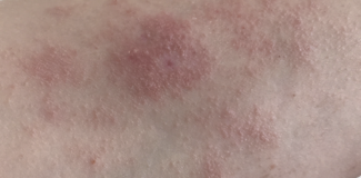 eczema image