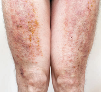 eczema on legs