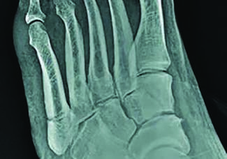 Fifth metatarsal fracture