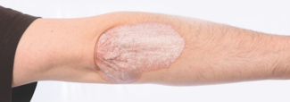 psoriasis on arm