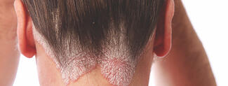 psoriasis on neck