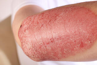 severe psoriasis on elbow