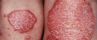 psoriasis on thighs