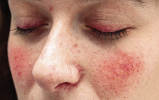 rosacea flares