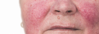 rosacea flare on cheek