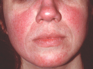 rosacea on face