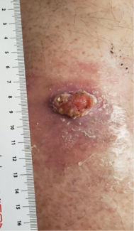 Squamous Cell Carcinoma