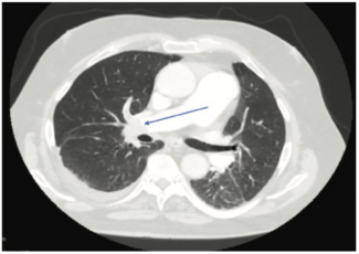 Elzanaty Clot Figure 1