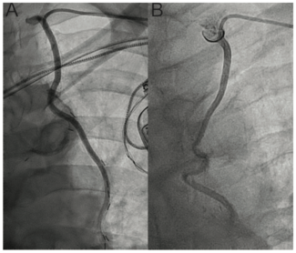 Kunnirickal Ipsilateral Figure 2