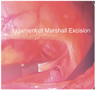 Morris Hybrid Ablation TN