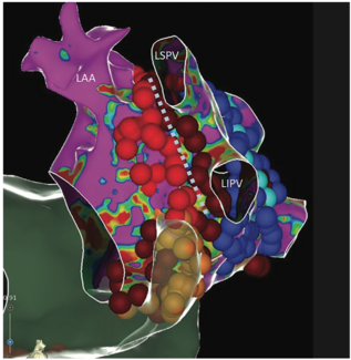 Richardson Ablation Figure 4