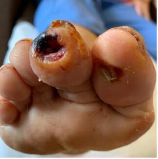 Fusarium osteomyelitis case report publication