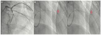 Varga Calcified Coronary Lesions TN