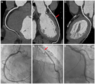 van Beek Coronary Angiography Figure 1