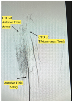 AliBailey Infrapopliteal TN