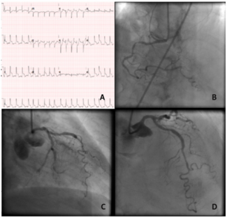 Araujo STEMI Figure 1