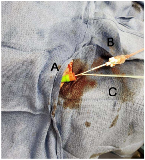 Caballero Aortic Stenosis Figure 1