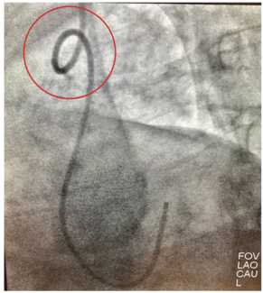 Casazza Kinked Catheter Figure 1