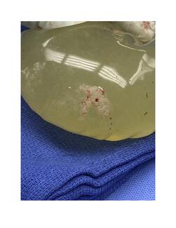 Figure 3. White fungal coating with green saline inside the intact infected left breast implant. 