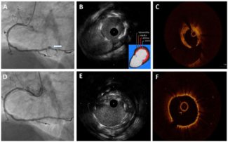 Guerrero Coronary Artery Rupture Figure 1