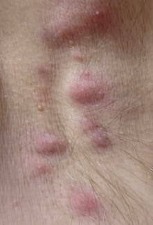 hidradenitis suppurativa under arm