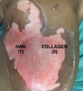 human amniotic membrane vs collagen in burn wound care