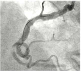 KhatriTerumo Complex PCI TN
