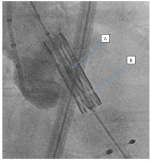 Mailey Heart Valve TN