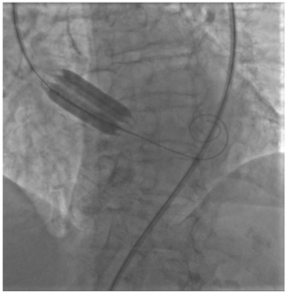 Scalone Valvuloplasty TN