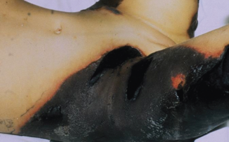 This lesion developed 24 to 48 hours after beginning warfarin therapy.