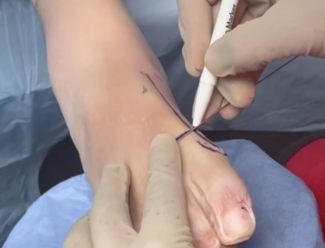 MIS Bunion Surgery