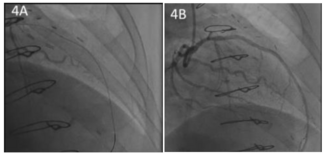 Abdelwahed Coronary Artery Tenting Figure 4