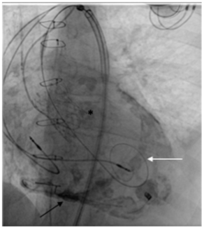 Ezad Transplanted Heart Figure 2
