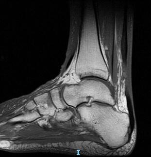 Achilles Rupture