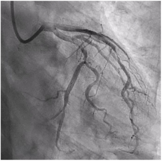 Kutkut STEMI Figure 3