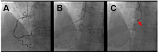 Lorenzoni Stent Dislodgment Figure 1