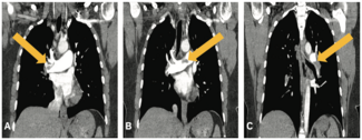 Merchen Pulmonary Embolism TN
