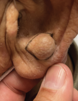Rubbery Nodule on the Antitragus