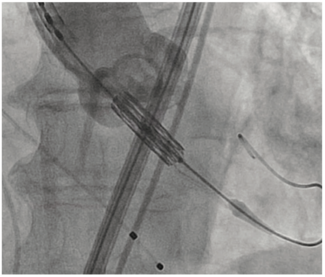 Shah Aortic Valve TN