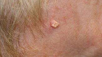 squamous cell carcinoma on head