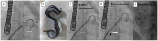 Veeraraghavan Atrial Septal Occluder Figure 1