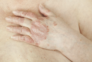 psoriasis on hand and stomach