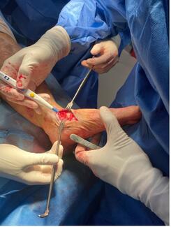 Hindfoot correction