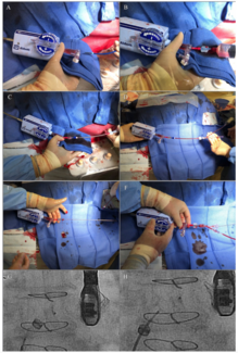 Bernstein Atrial Septal Defect Figure 2