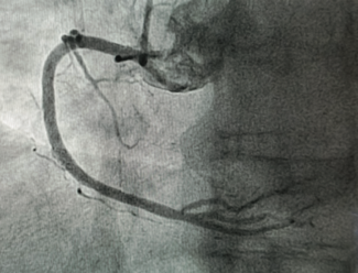 Bhattad Coronary Vasospasm TN